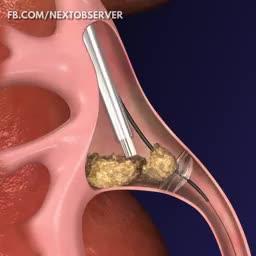 this-is-how-doctors-remove-kidney-stones-1-1-
